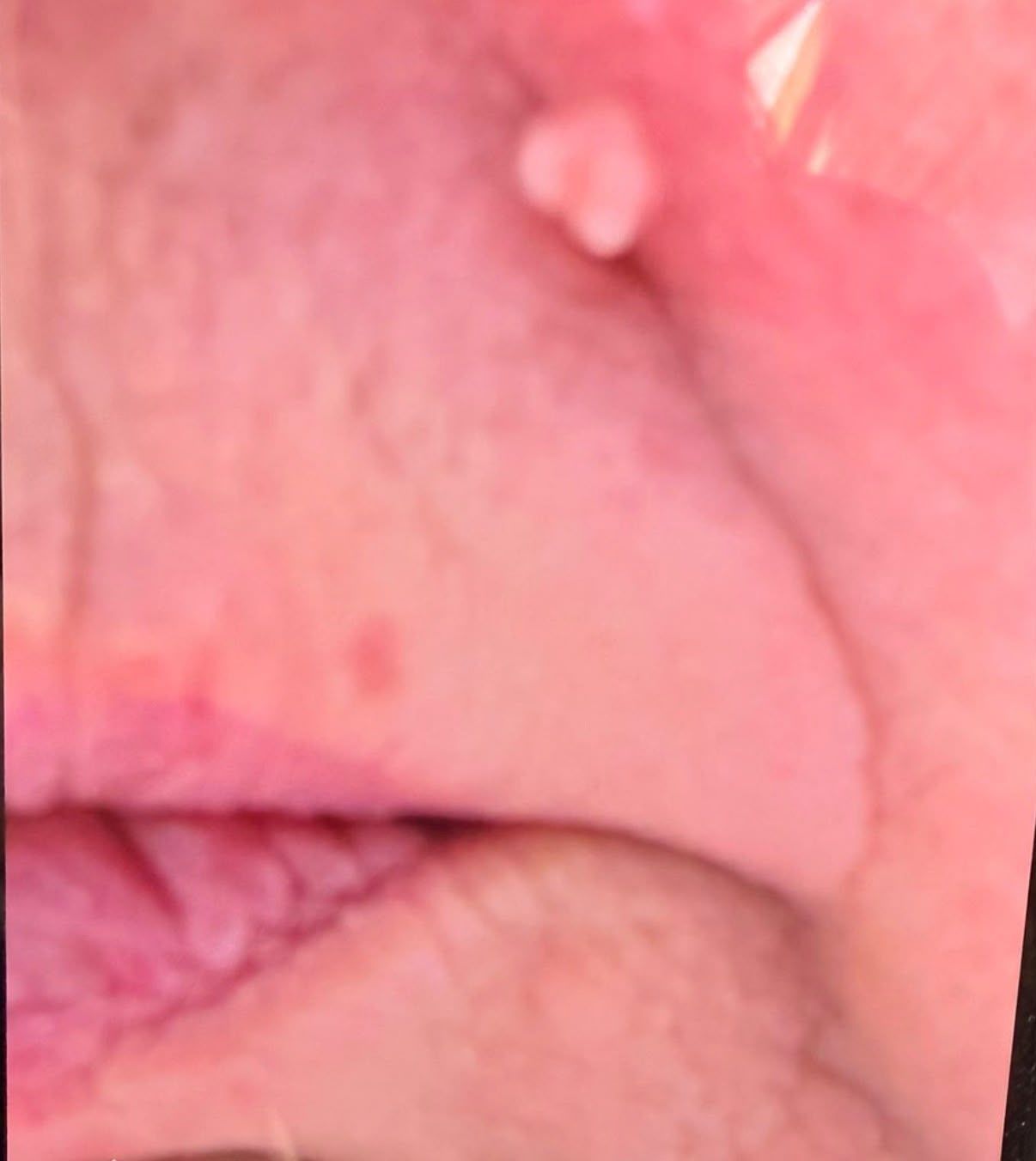 Skin Tag Before Picture