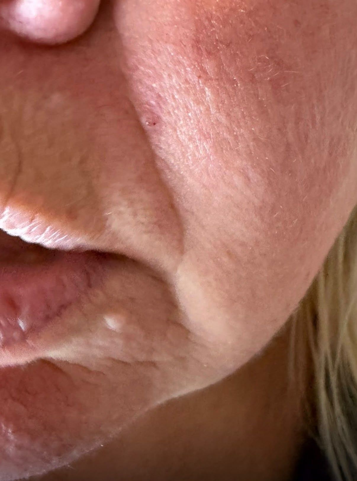Skin Tag Before After