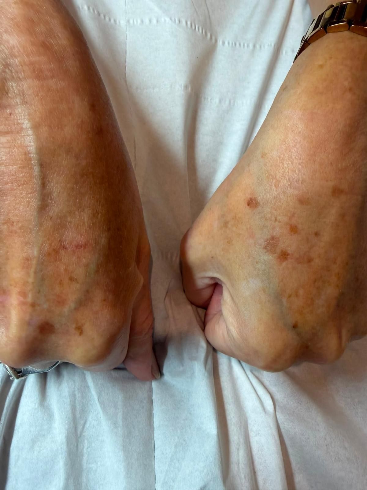 Before cryotherapy: backs of a client’s hands with brown age spots