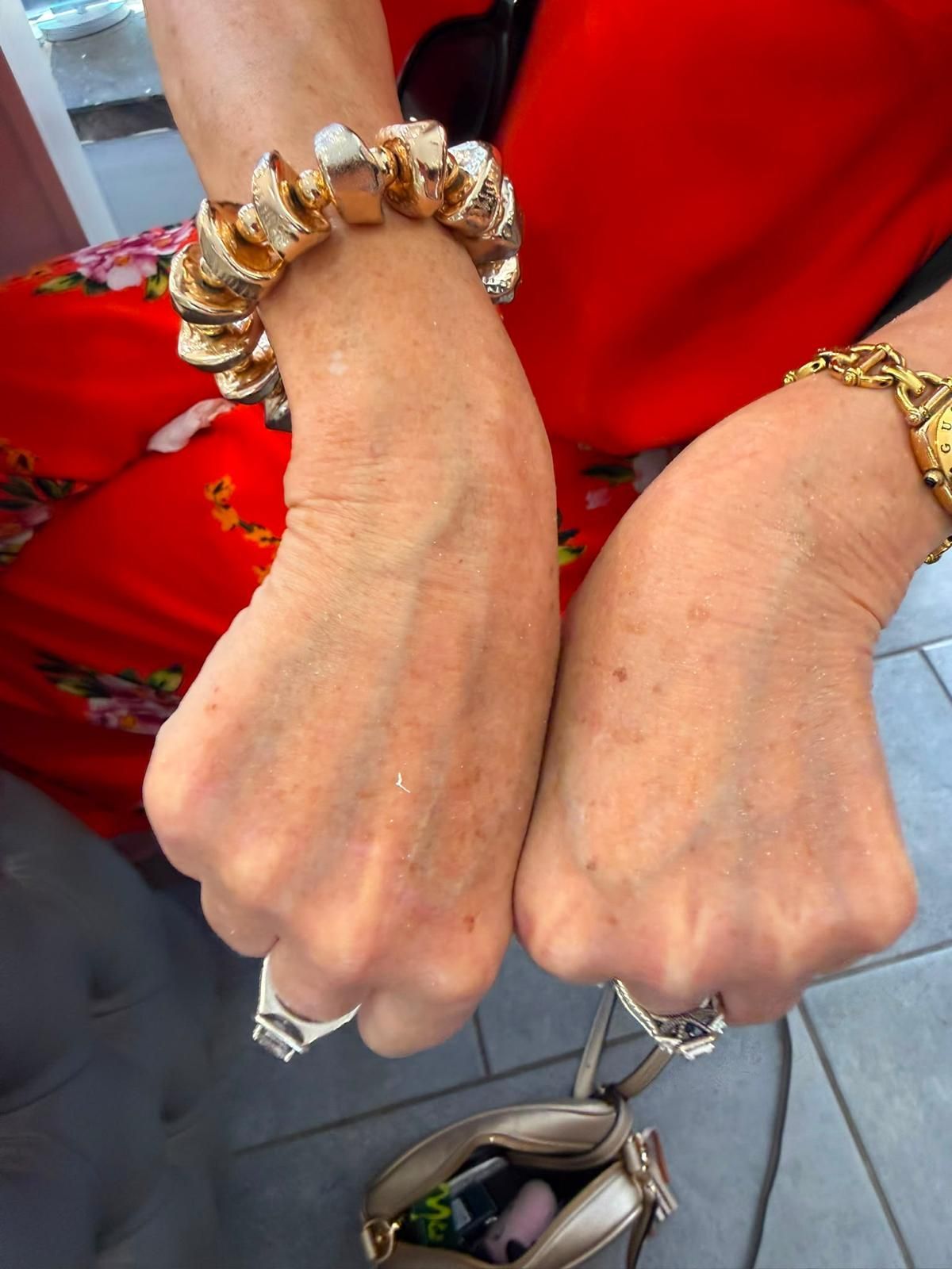 After cryotherapy: backs of a client’s hands with the brown age spots lighter or removed
