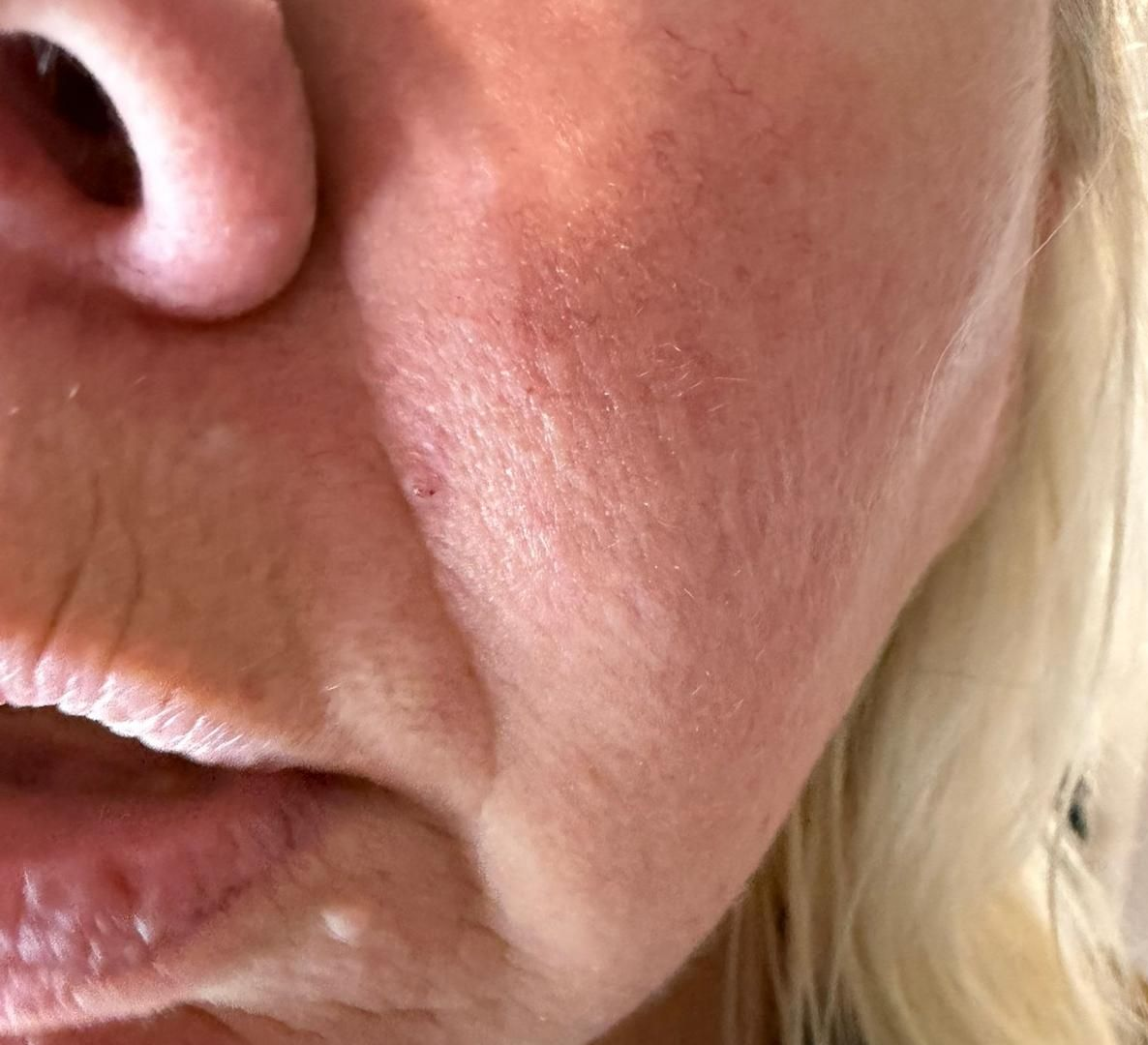 After cryotherapy: the same area of the client’s face beside the nose with the skin tag removed