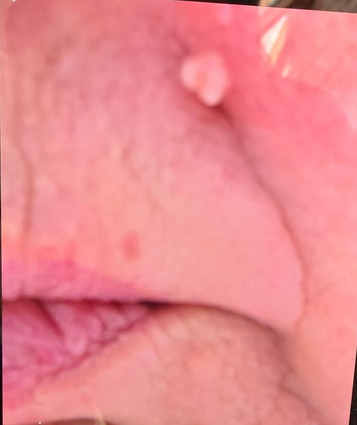 Before cryotherapy: small skin tag on a client’s face beside the nose and upper lip