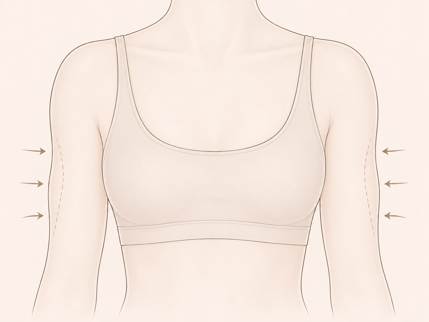 Illustration of upper-arm areas targeted during body contouring
