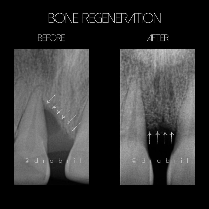 Dental X-ray comparison showing bone regeneration between two teeth before and after treatment, marked by white arrows.