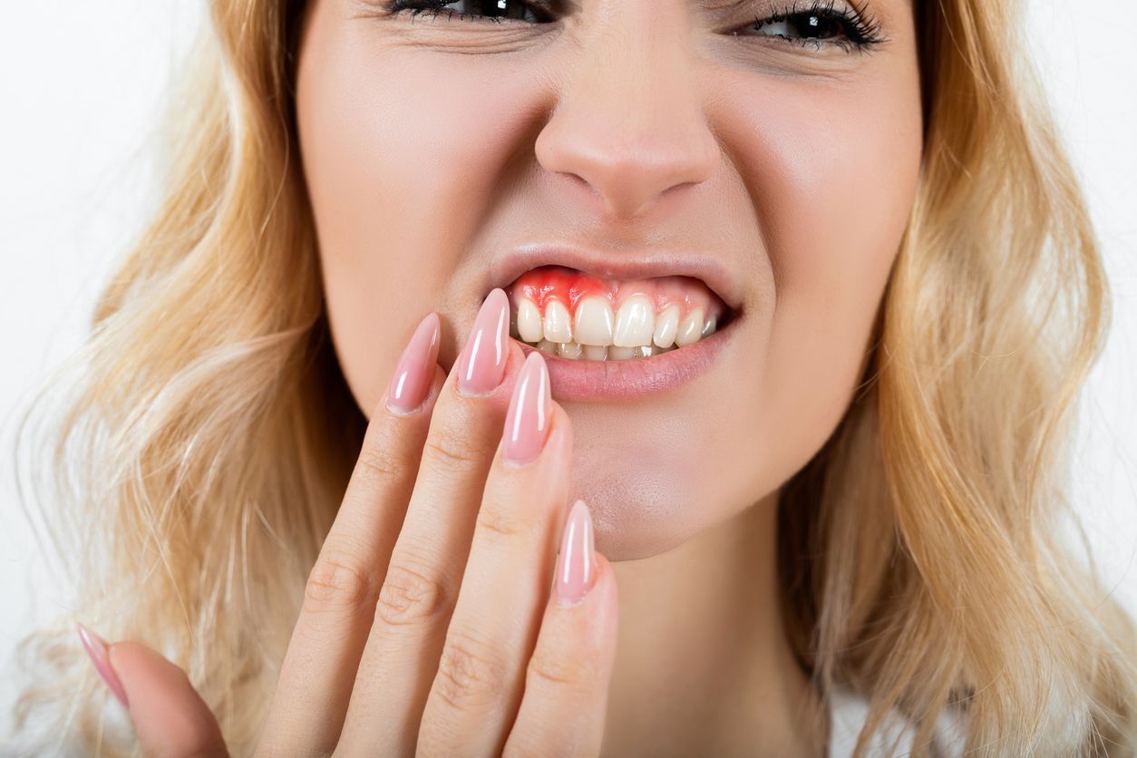 Woman with inflamed gums, clenching her teeth, touching her mouth. Redness is visible.