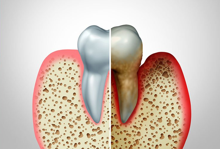 A tooth is shown before and after being removed.