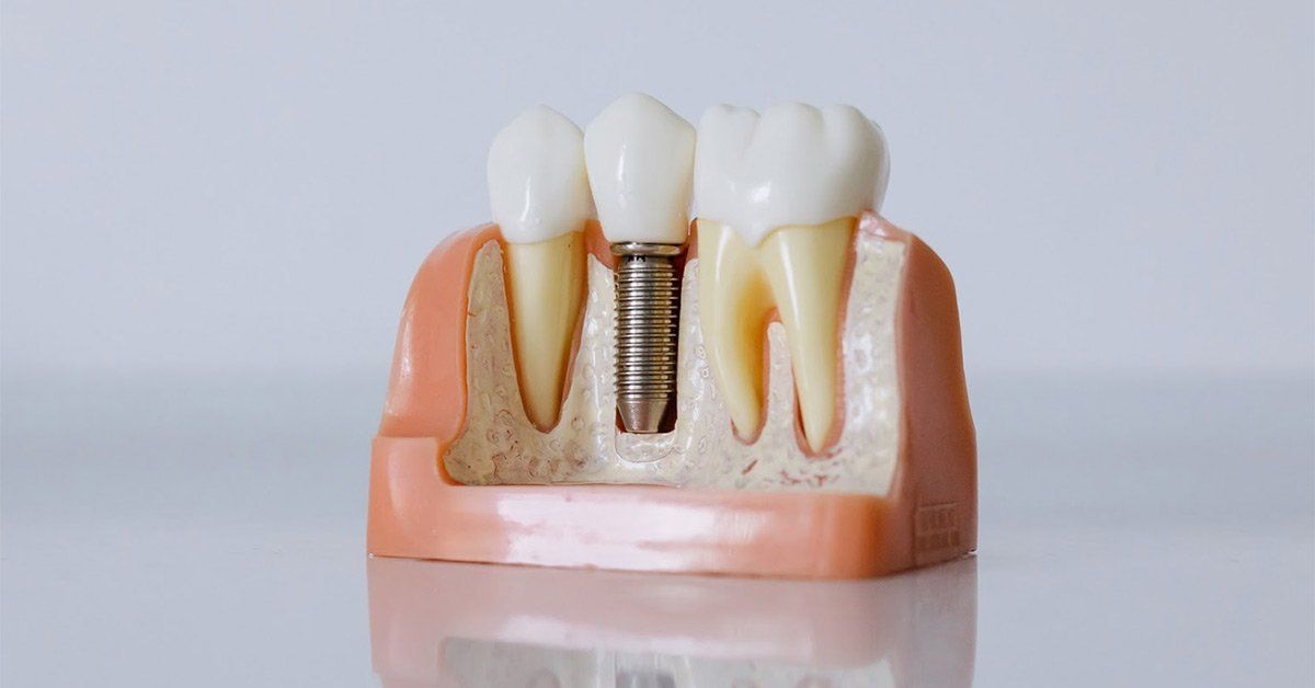 dental implant image