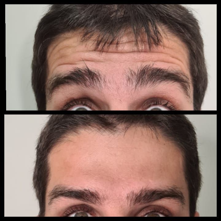 Toxina Botulínica