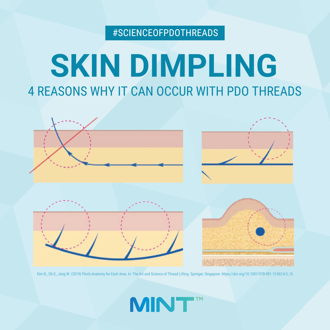 How Dimpling Occurs and How to Address Them Skin Dimpling with PDO Threads