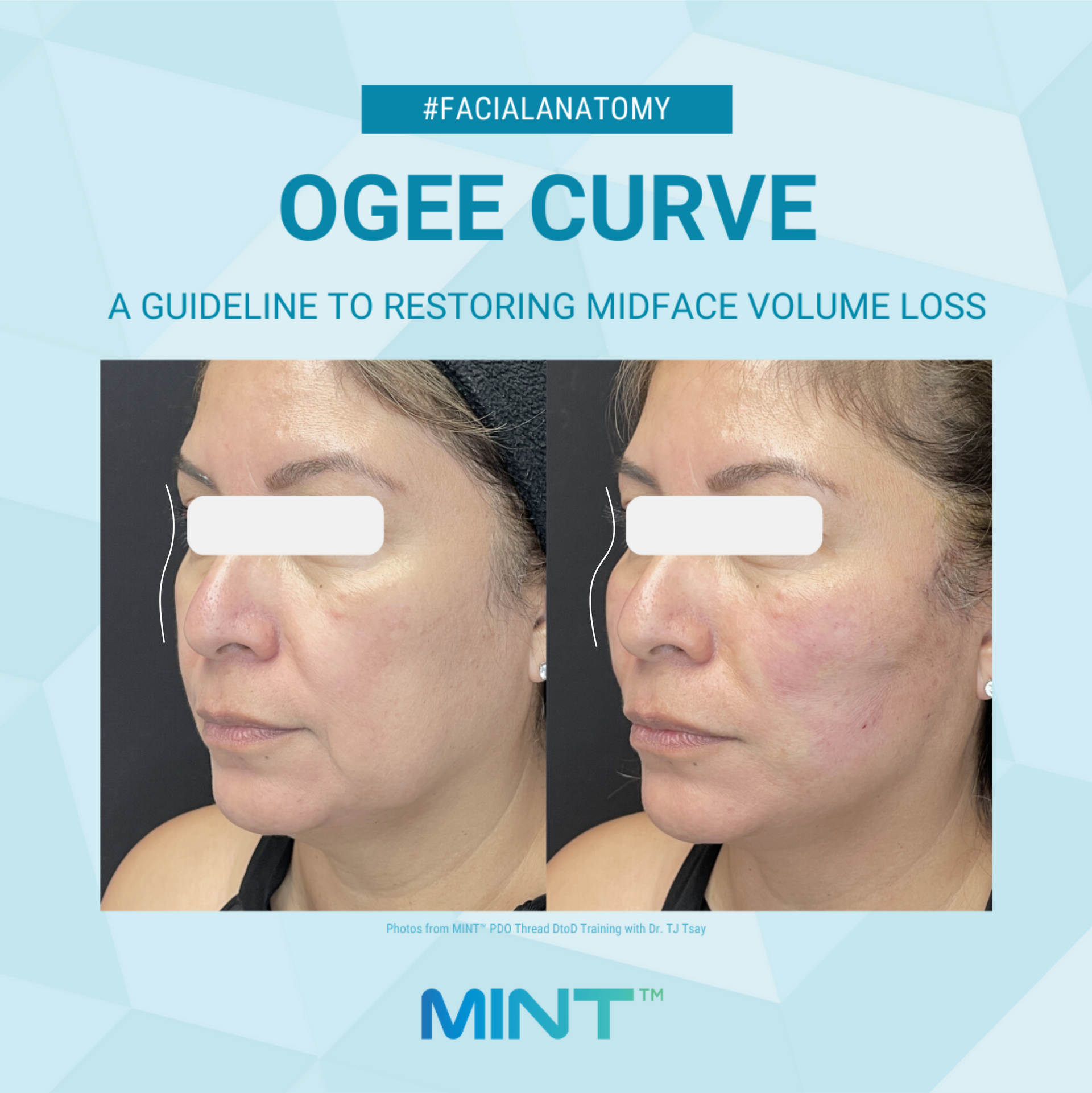 Restoring the ogee curve with MINT PDO threads