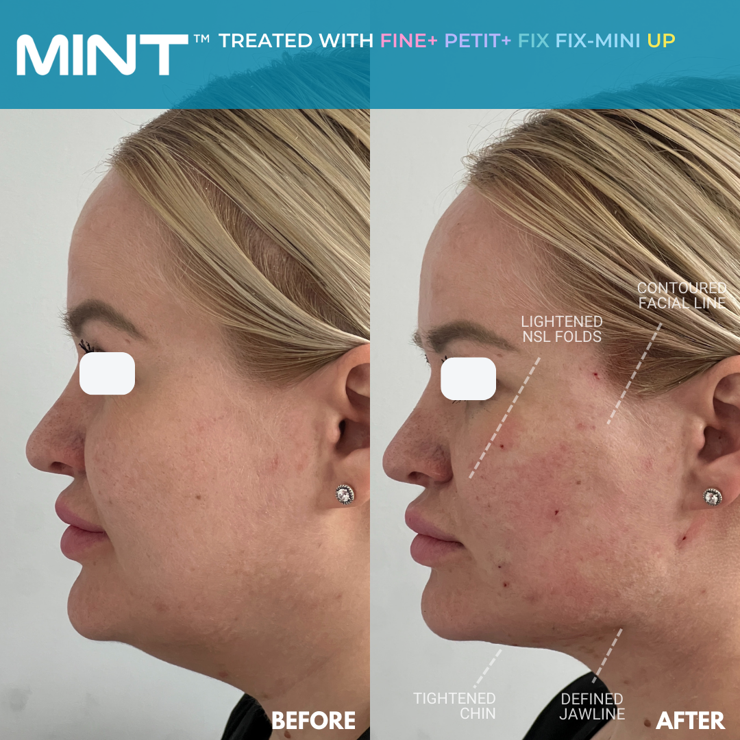side view of thread lift before and after of woman getting thread lift