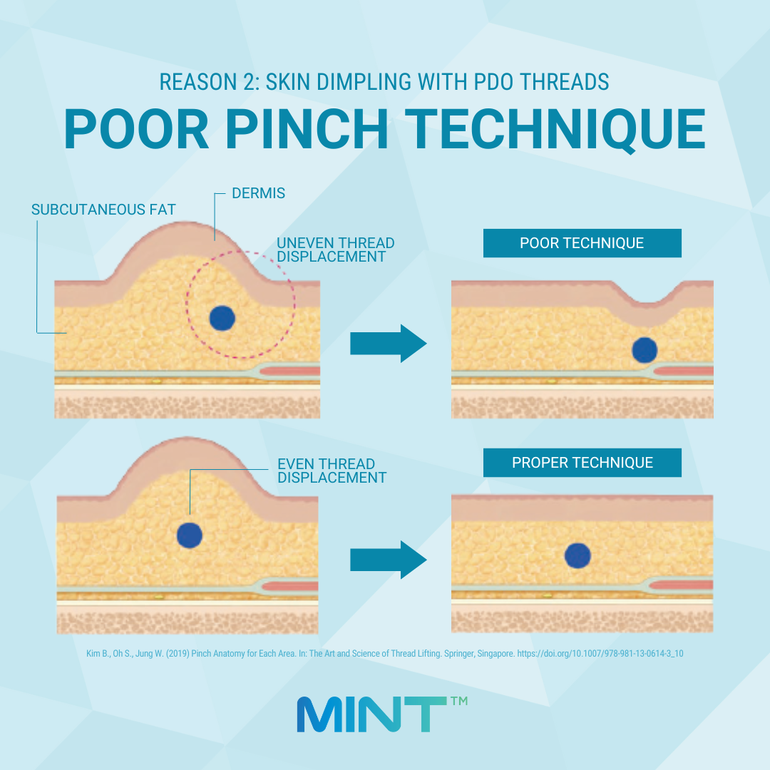 Thread must be evenly displaced when utilizing pinch technique PDO Thread Skin Dimpling from Poor Pinch Technique