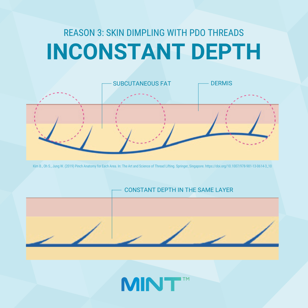 It is important to maintain a constant angle and pressure during thread insertion. PDO Thread Skin Dimpling from Inconstant Depth