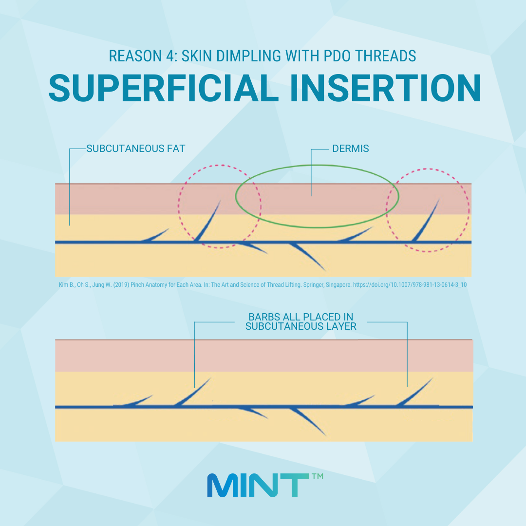 Practitioners must avoid staying too superficial in the subcutaneous layer to minimize barbs from catching in the dermis. PDO Thread Skin Dimpling from Superficial Insertion