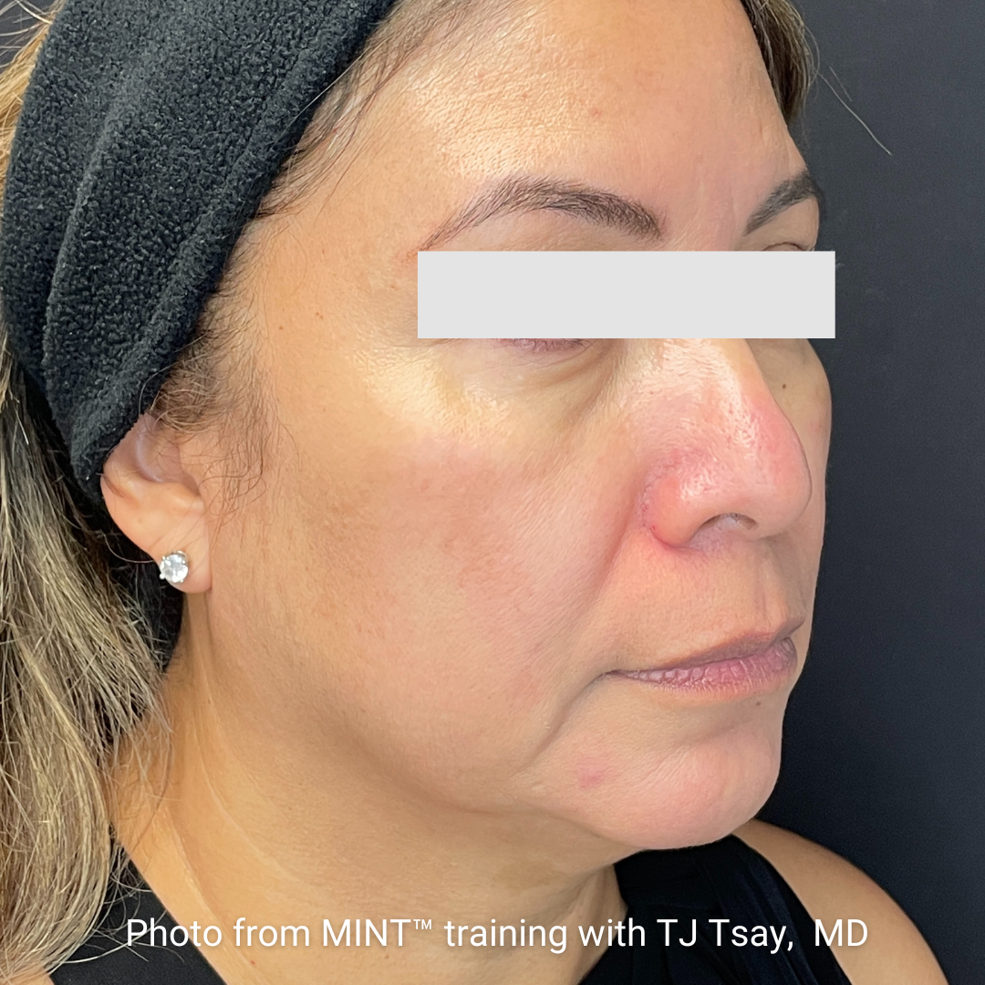 MINT™ PDO Thread Lift Before & After photo