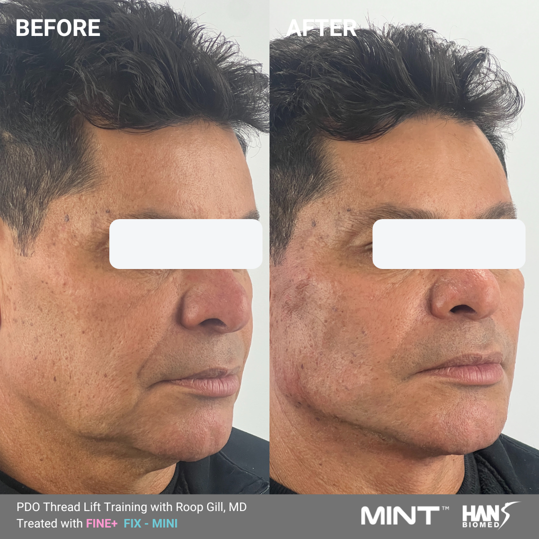 PDO Thread before and after for men
