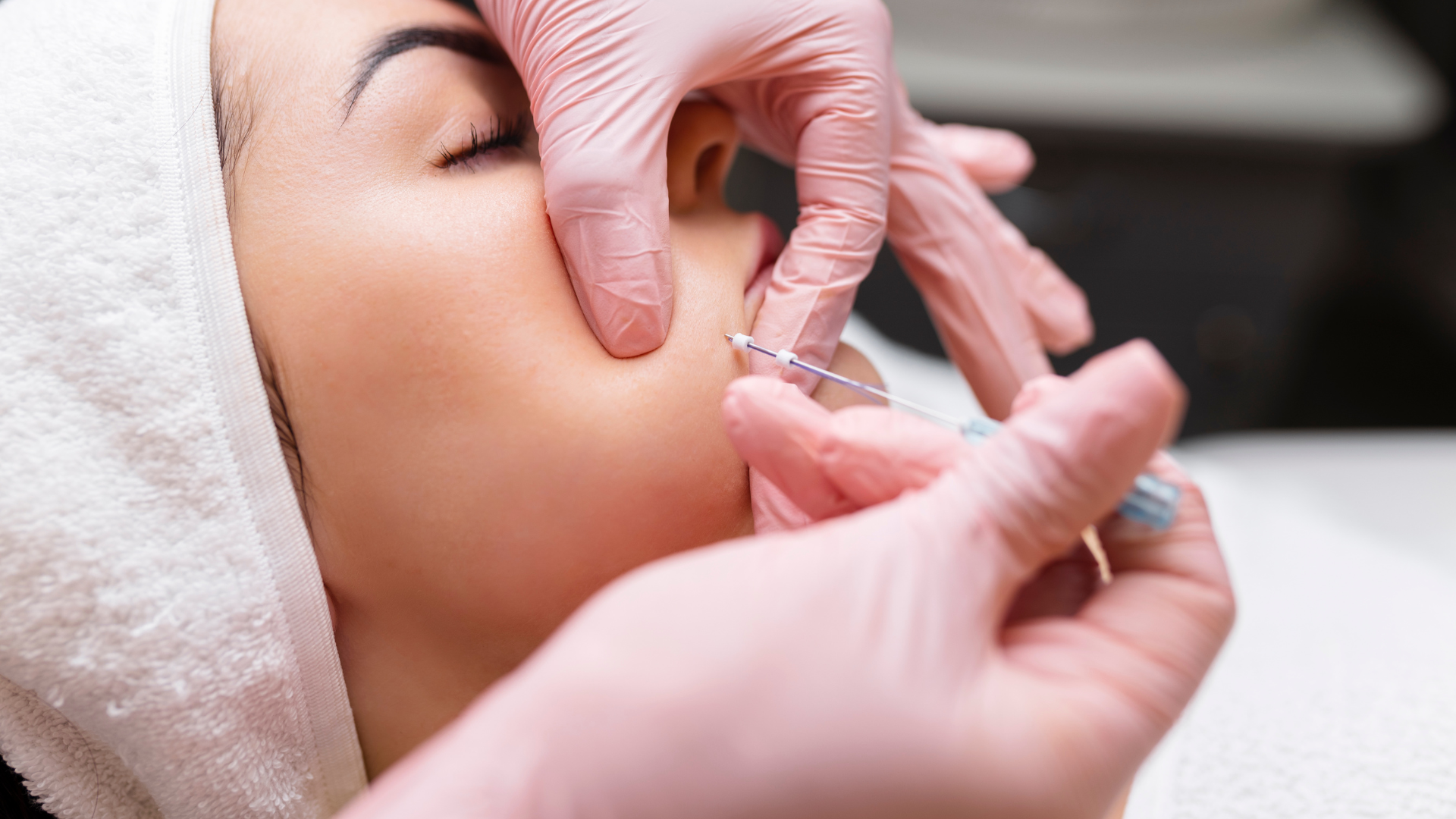 PDO thread lift for midface