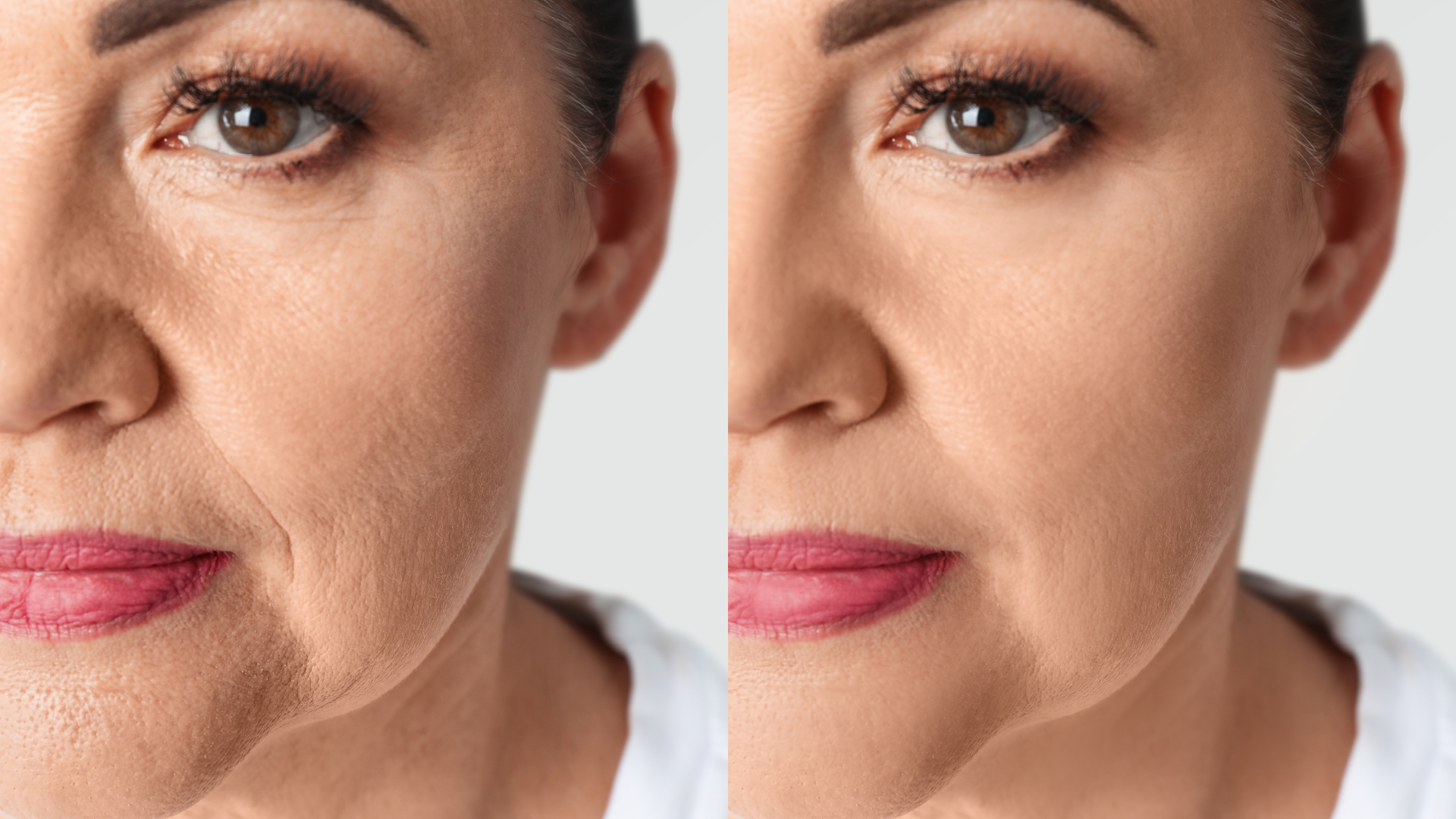 Before and after of a PDO thread lift for smile lines and nasolabial folds