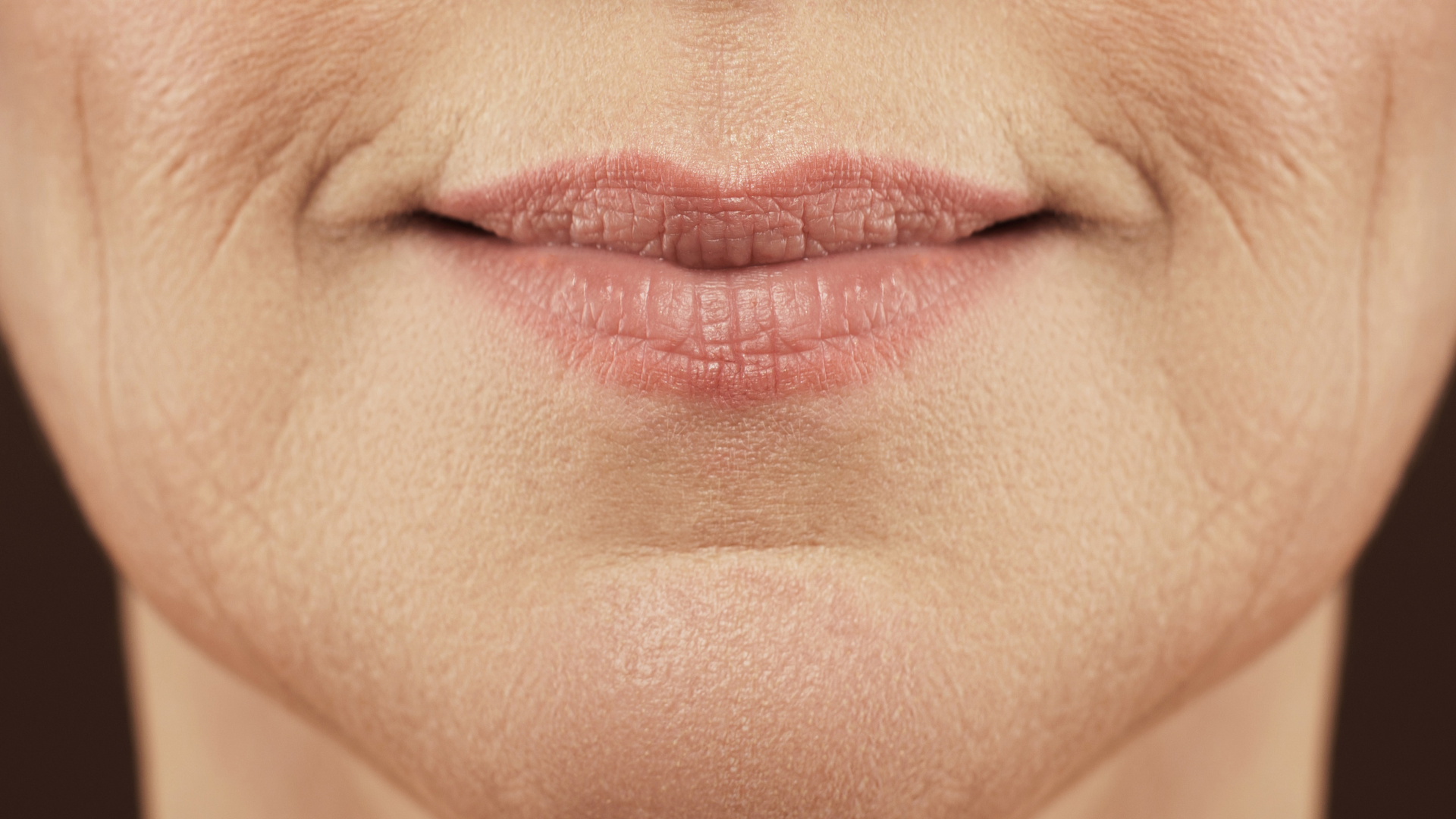 Woman with smile lines, preparing to get PDO thread lift