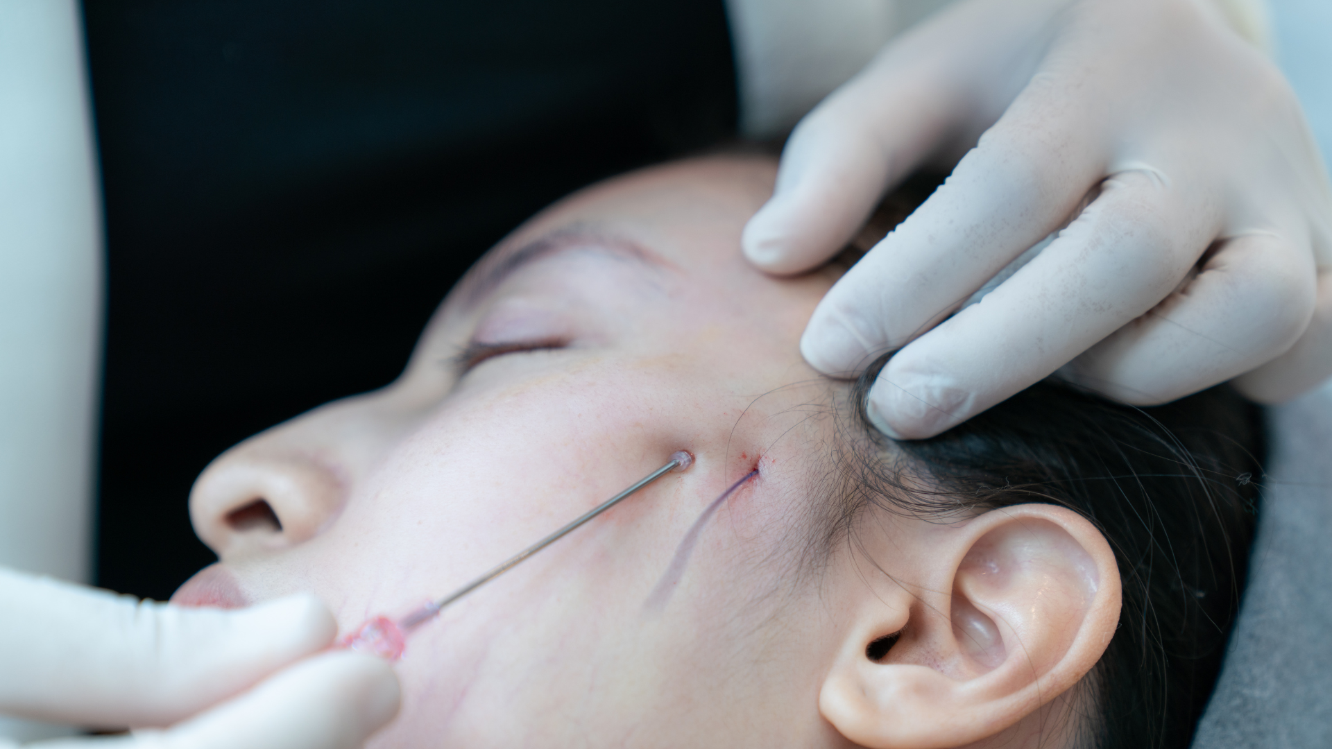Woman getting pdo threads inserted in face