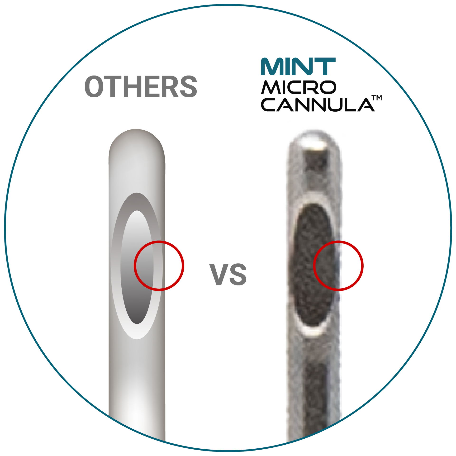 Ultra thin wall
