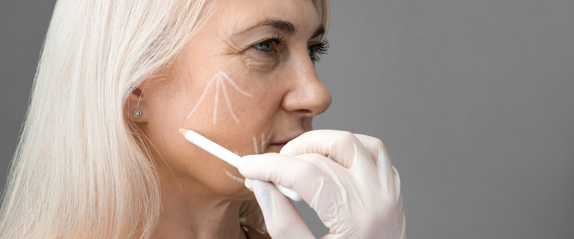 Drawing vectors on the face for a PDO thread lift