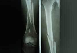 DR CARLOS SANCHEZ GUERRERO - OSTEOPOROSIS