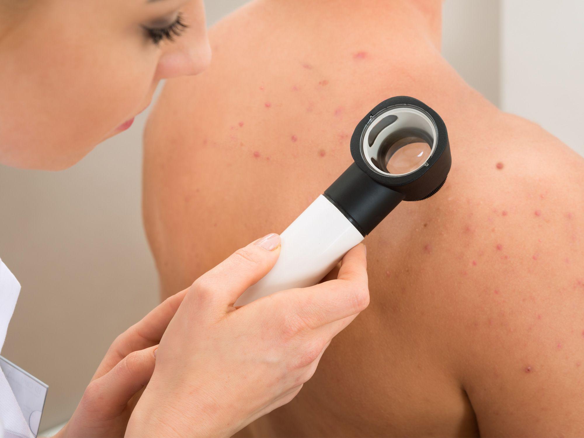 DR. HILDORFO GENCHI SOLÍS – URTICARIA