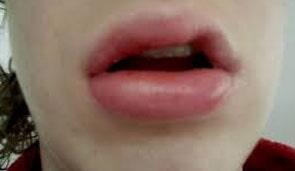 DR. HILDORFO GENCHI SOLÍS – ANGIODEMA