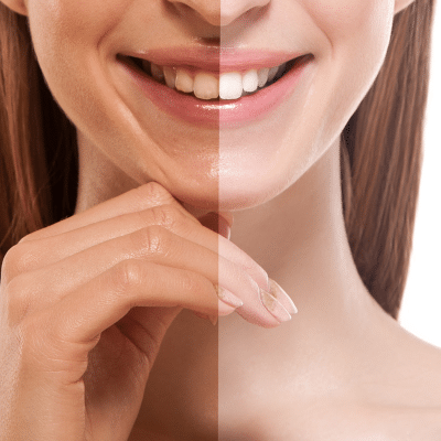 Woman smiling | Before and After teeth cleaning and whitening at our King George VA dentist