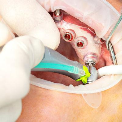 Top family dentist in King George VA doing guided dental implant surgery