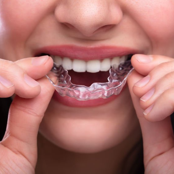 Clear aligners in University heights