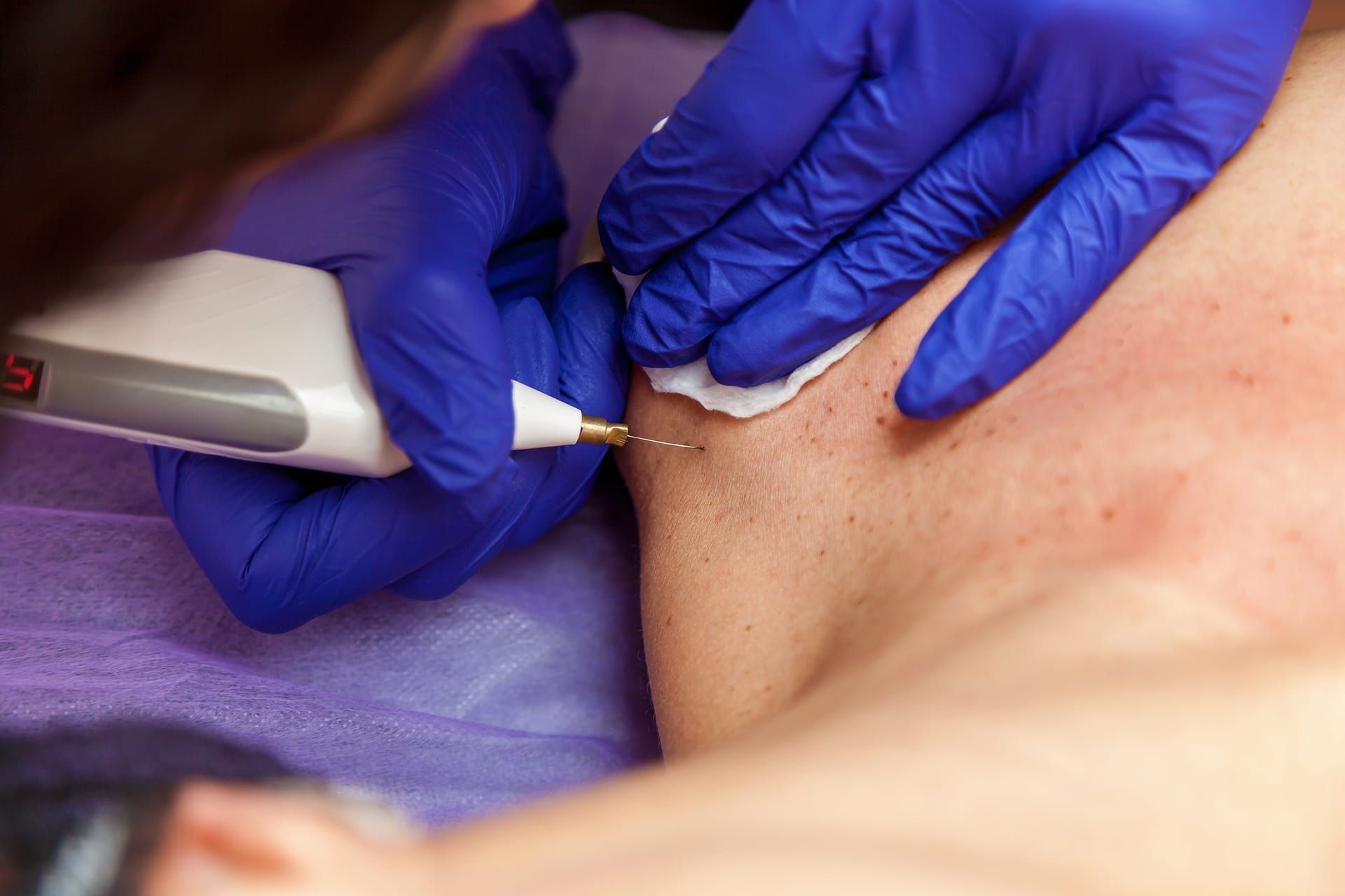 Removing Papillomas On A Girl's Body With An Electro Coagulator โ Rural Medical Clinic In Manilla, NSW