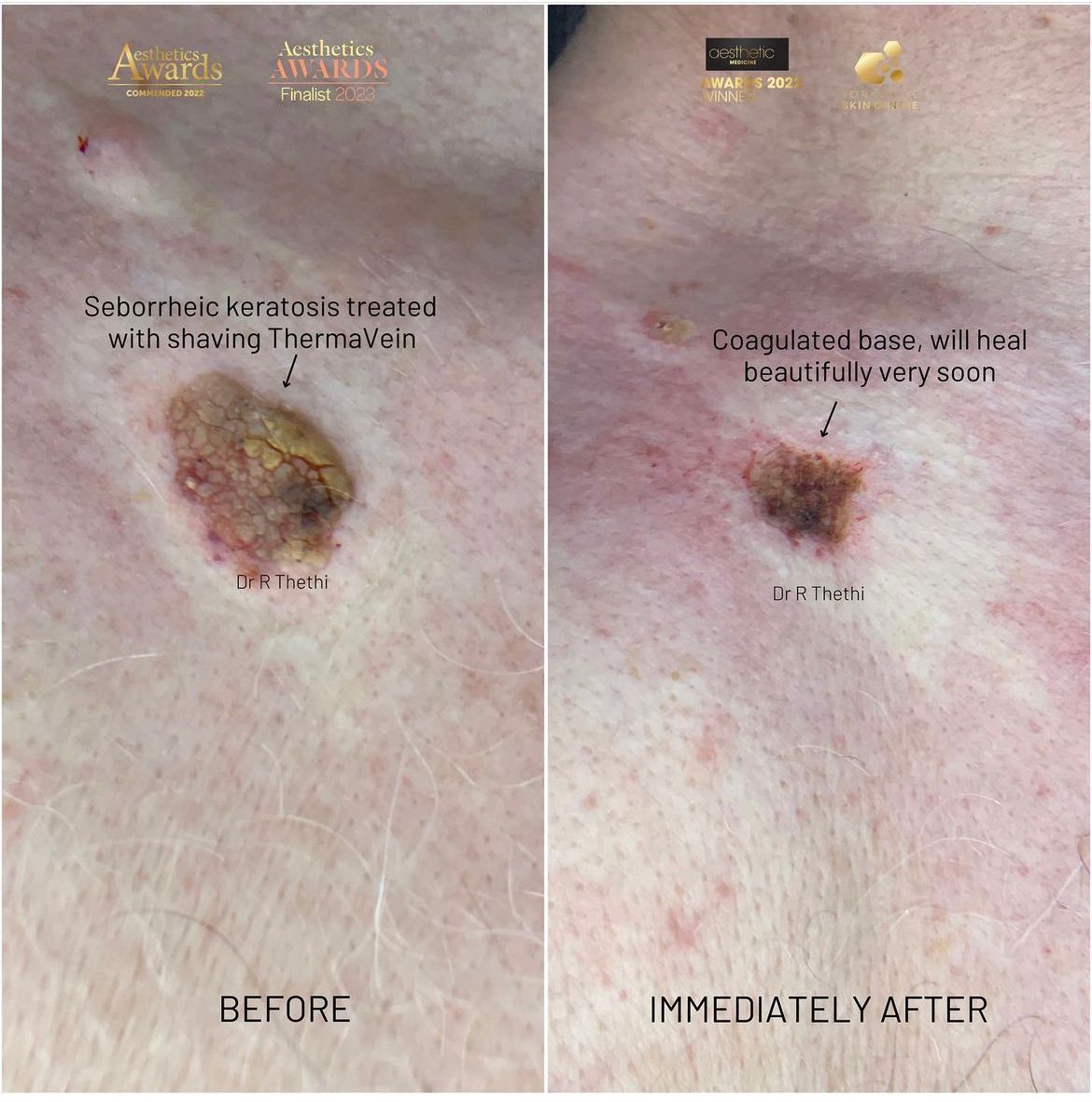 aesthetic-treatment-results-gallery-yorkshire-skin-centre