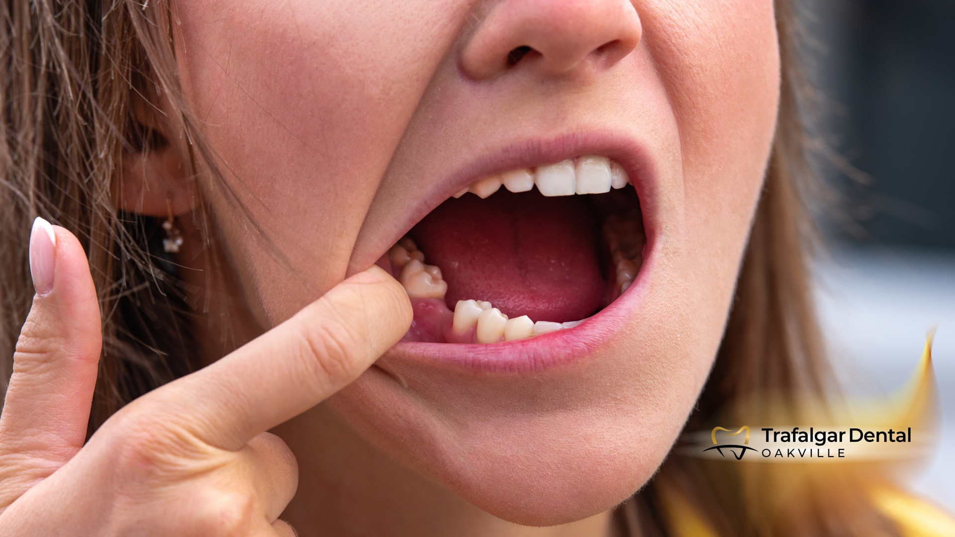 A woman is pointing at her missing tooth in her mouth.