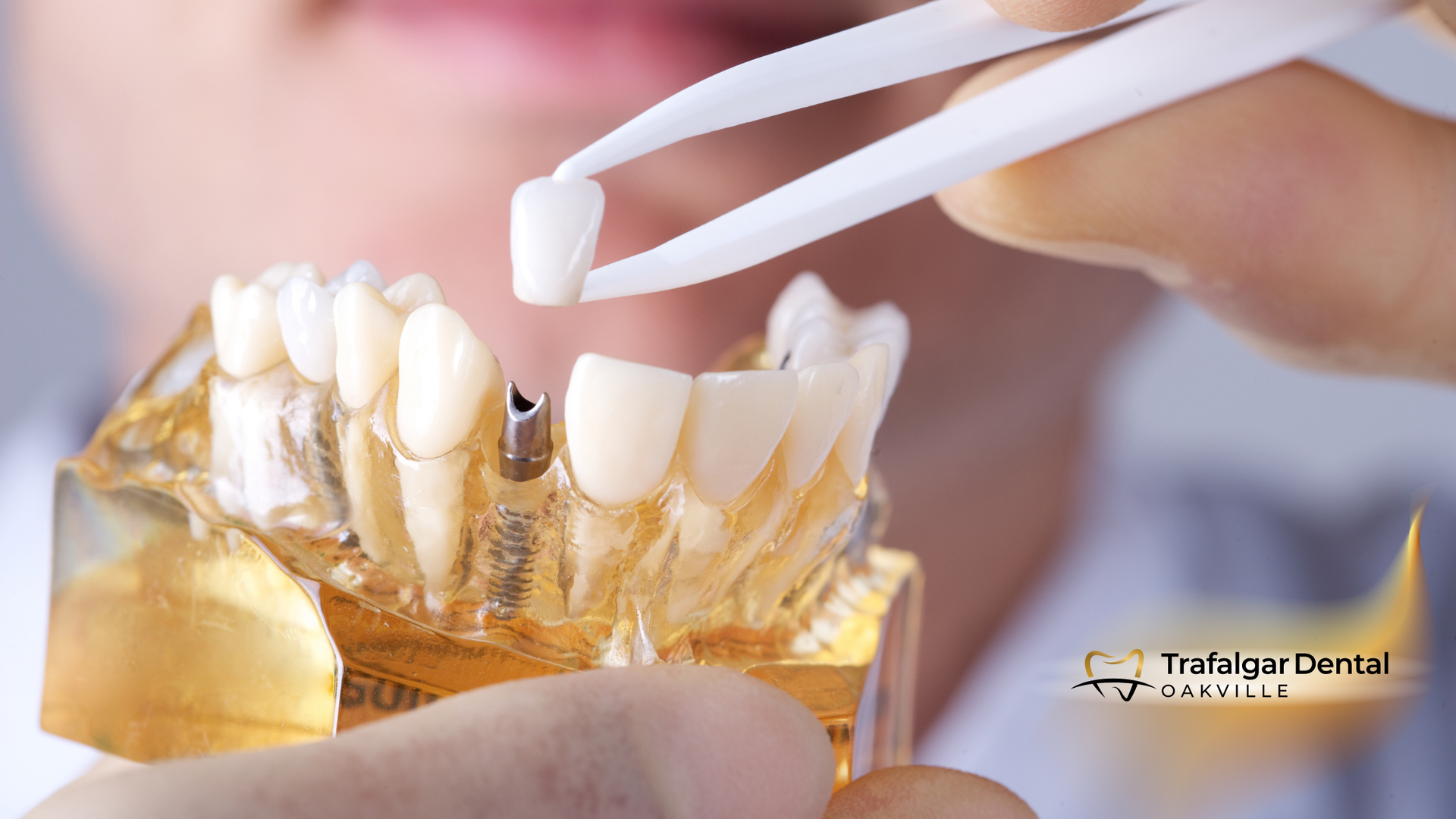 A person is holding a model of a person 's teeth with tweezers.