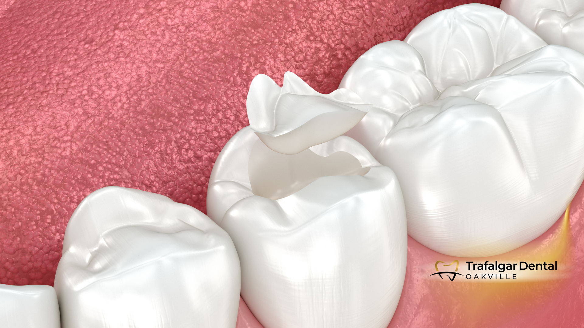 A close up of a tooth with a filling in it.
