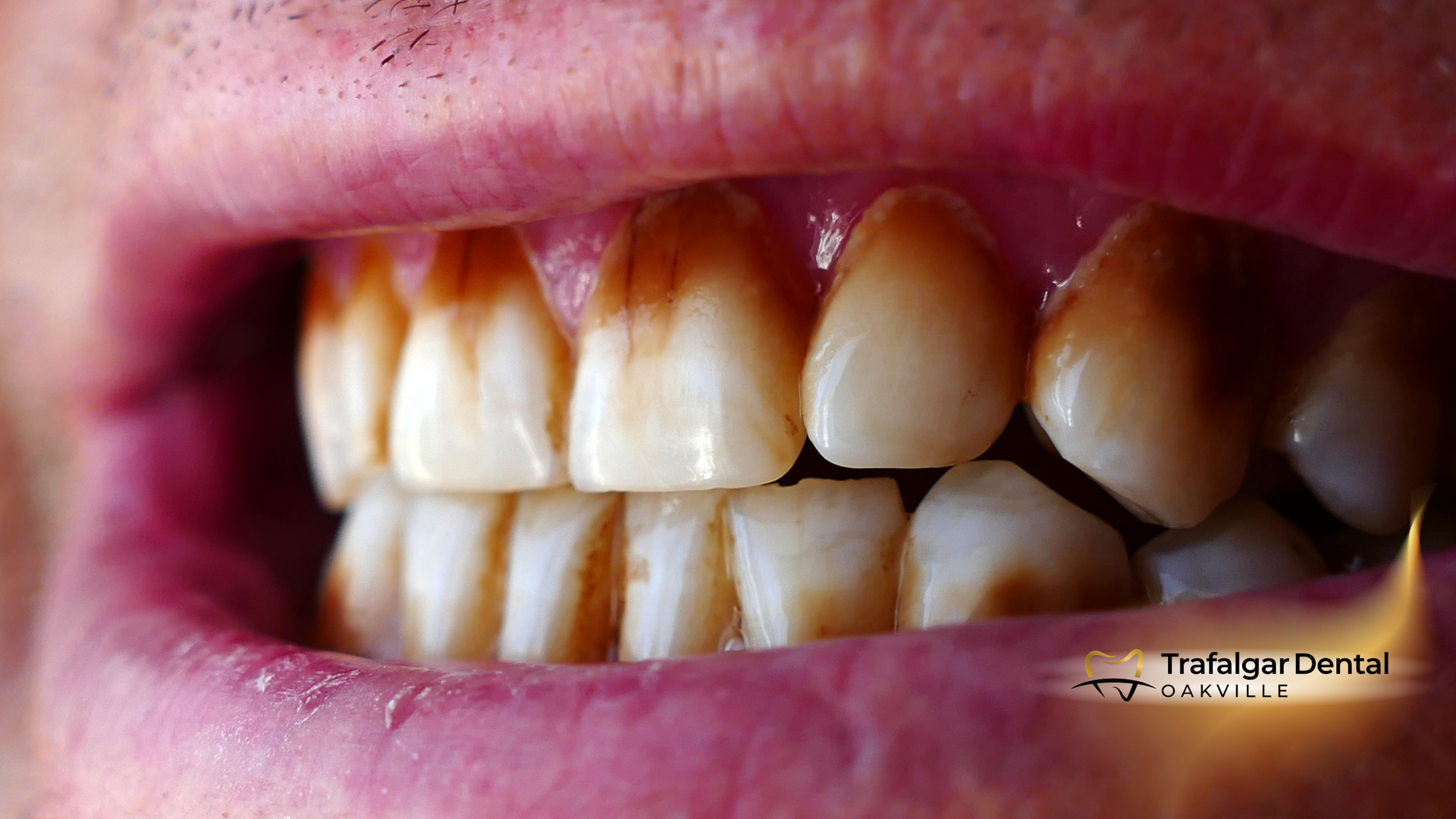A close up of a person 's teeth with brown spots on them.