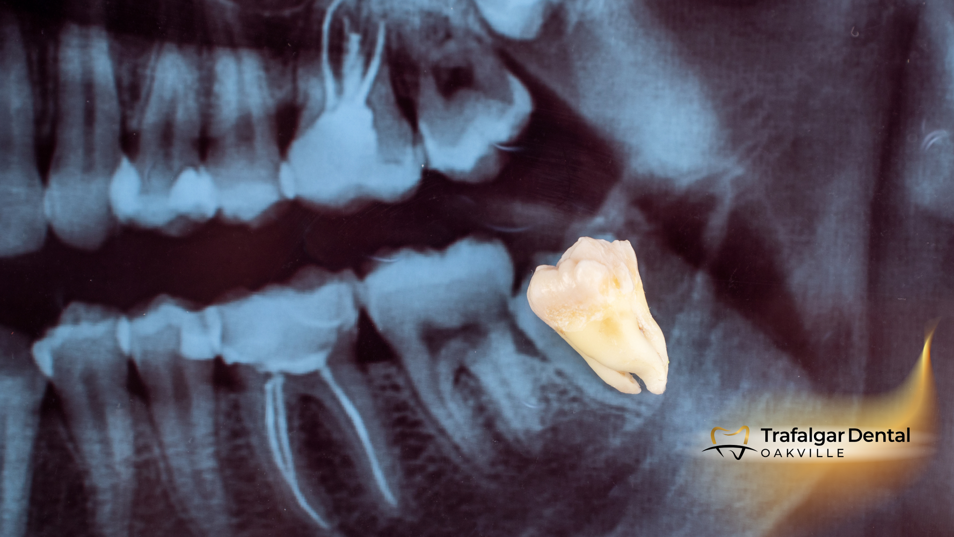 An x-ray of a person 's teeth shows a tooth that is missing