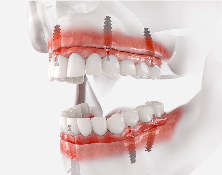 A 3d model of a person 's teeth with dental implants.