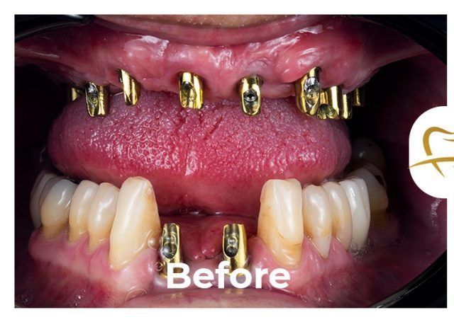A picture of a person 's teeth before dental work