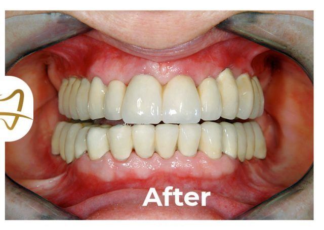 A picture of a person 's teeth after dental work