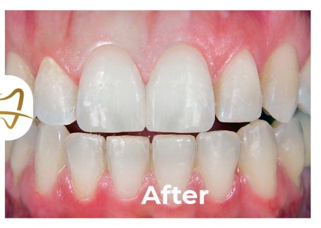A close up of a person 's teeth with the words after on the bottom