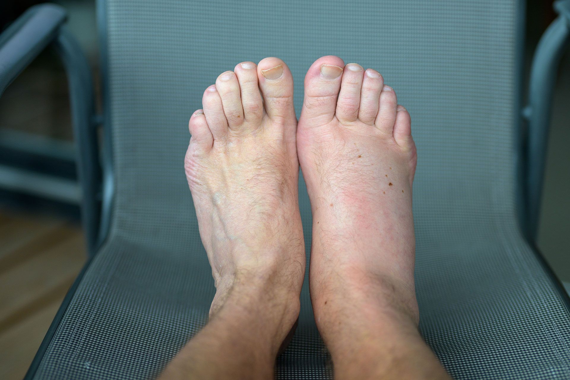 Achilles Tendonitis