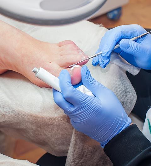 Infected Nail Treatment | Sheffield, AL | Martin Foot Specialists, Inc Infected Nail Treatment | Sheffield, AL | Martin Foot Specialists, Inc