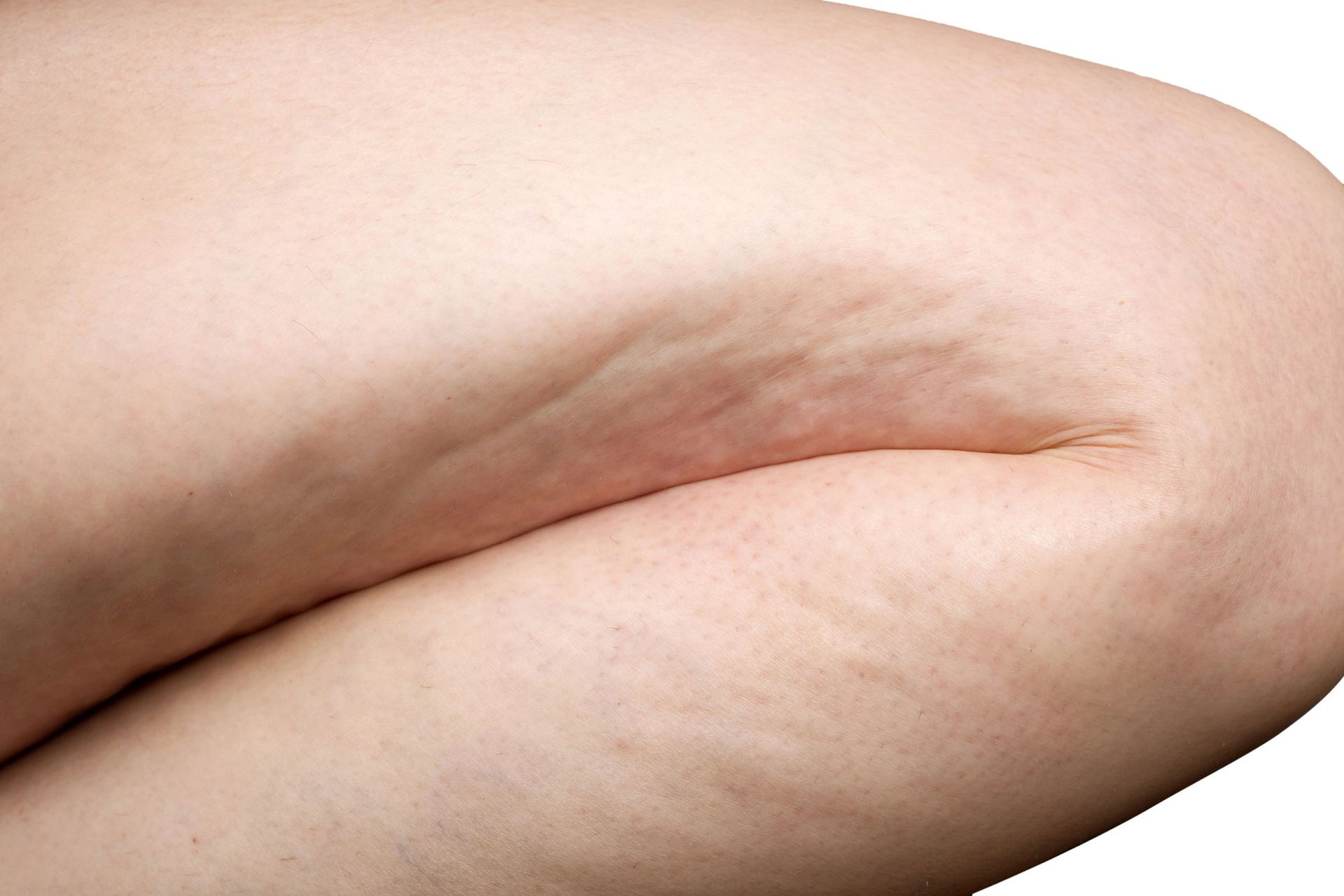 cellulite