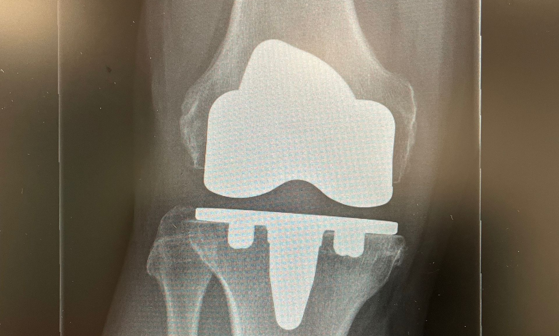 cementless knee replacement