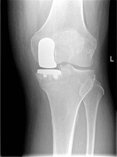An x-ray of a knee with a prosthetic knee joint.