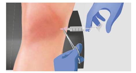 knee injections for arthritis
