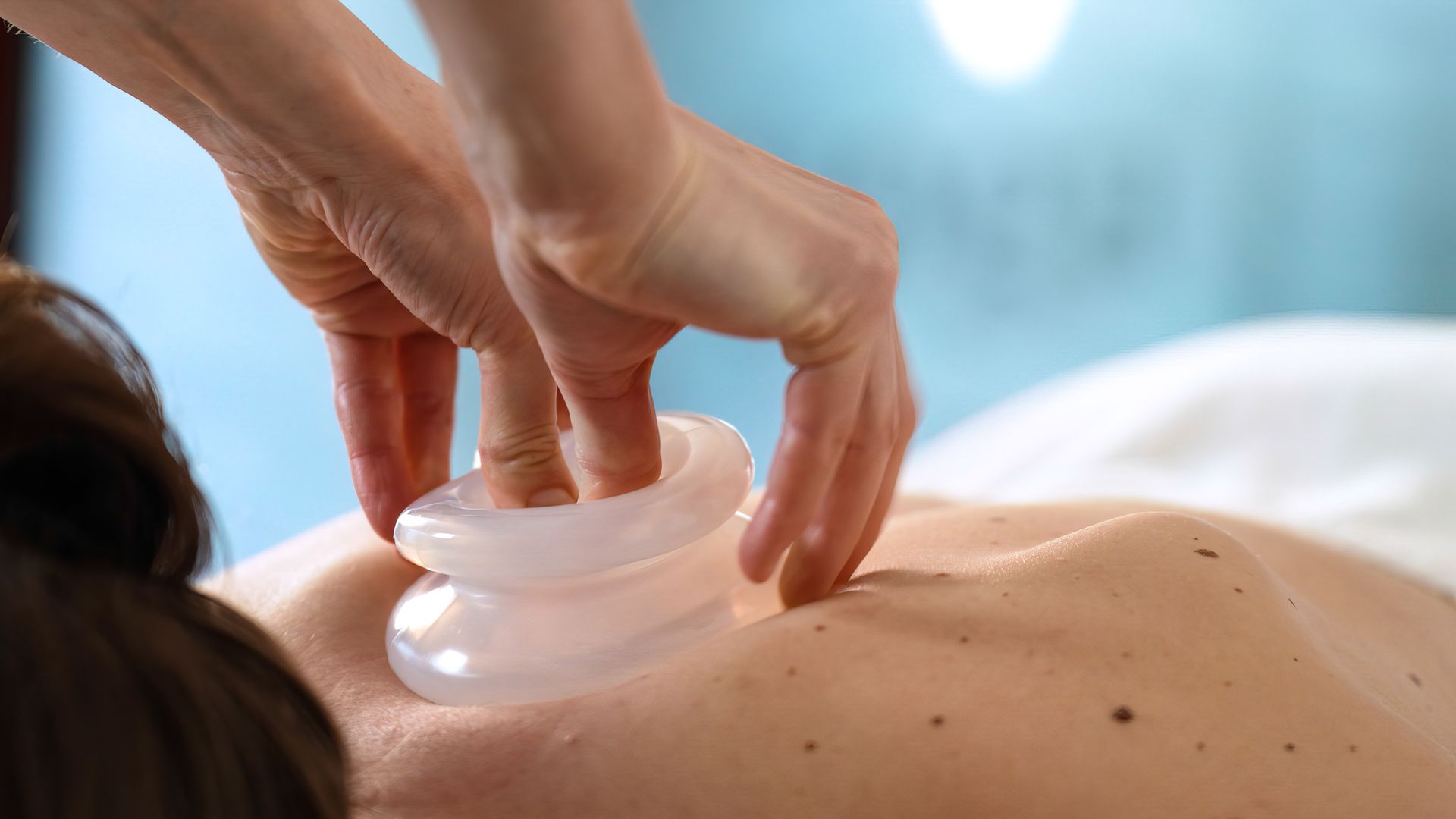 A practitioner performs fire cupping therapy on a person's back, using a flaming swab to create suction in glass cups.